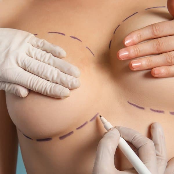 Breast Augmentation
