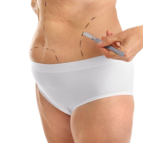 Liposuction